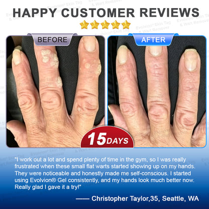 ✨BUY 1 GET 1 FREE✨✨👏Evolvion® Skin Tag & Wart Remover Precision Gel