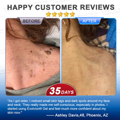 ✨BUY 1 GET 1 FREE✨✨👏Evolvion® Skin Tag & Wart Remover Precision Gel