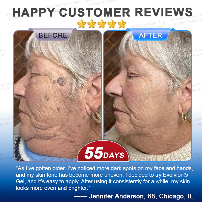 ✨BUY 1 GET 1 FREE✨✨👏Evolvion® Skin Tag & Wart Remover Precision Gel