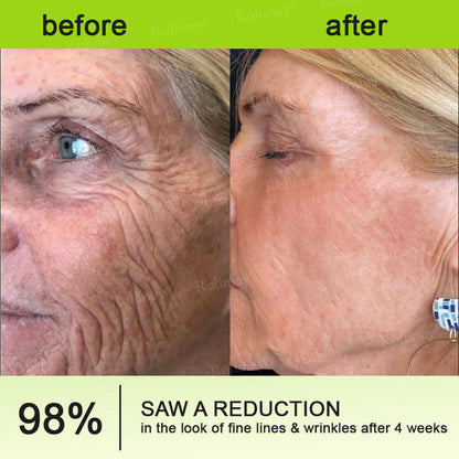 👍🌟💫Made and shipped from the UK 💫Rolimey® Botox & Vita-A Retinol Shot Wrinkle-Lift Tightening cream - Last Day Promotion 70% OFF