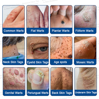 ✨BUY 1 GET 1 FREE✨✨👏Evolvion® Skin Tag & Wart Remover Precision Gel